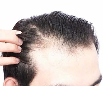 Behandlung von Haarausfall